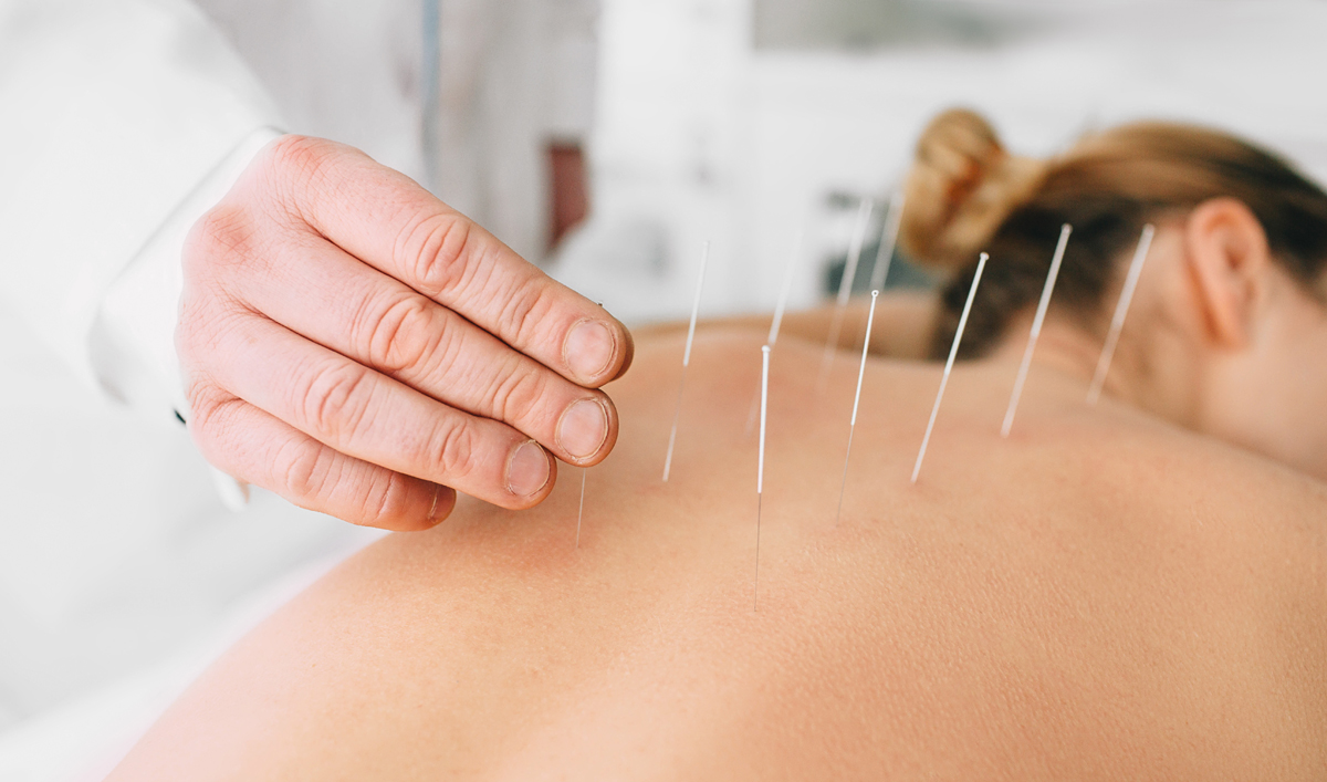 Therapies Acupuncture