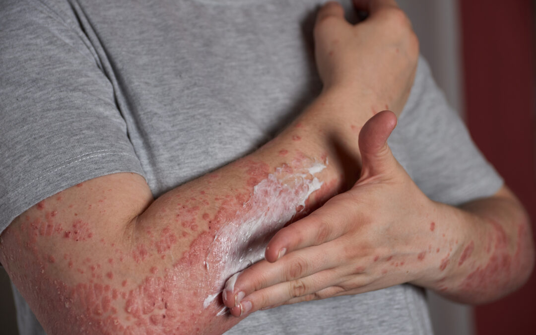Woman applying moisturizer to skin with psoriasis with her hand on her forearm
